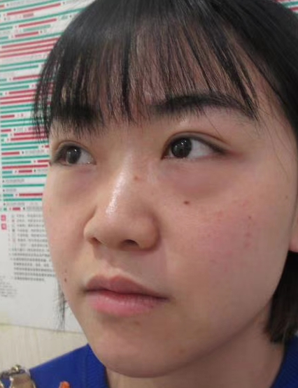 去眼袋手术