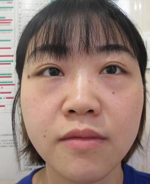 去眼袋手术