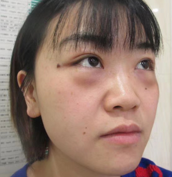 去眼袋手术