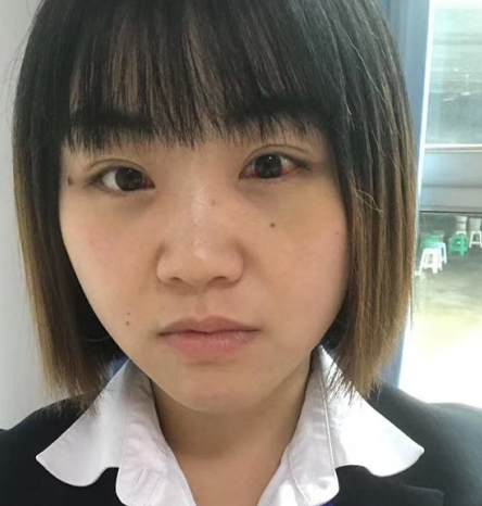 去眼袋手术