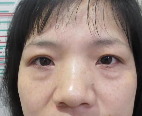 去眼袋手术