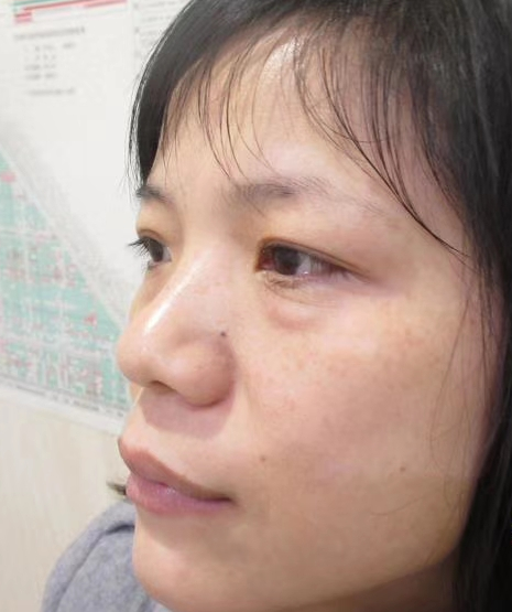 去眼袋手术