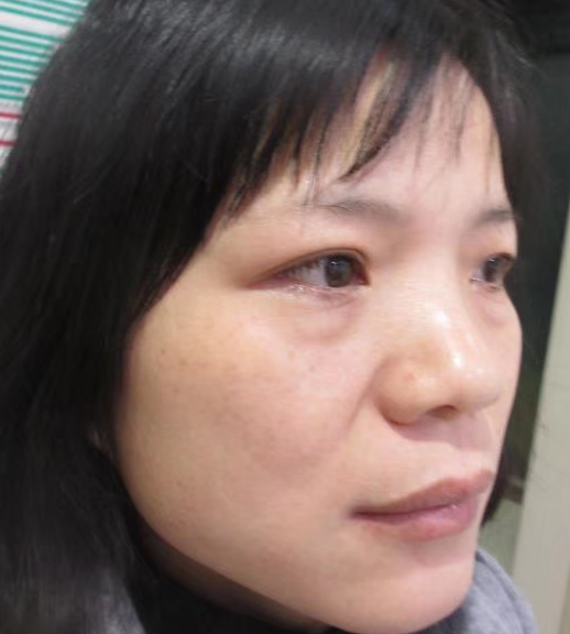 去眼袋手术