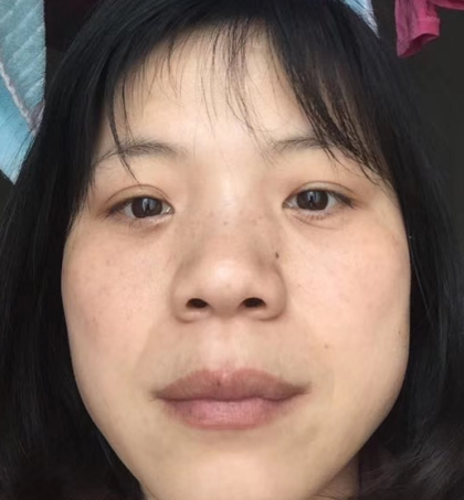 去眼袋手术
