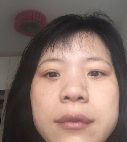 去眼袋手术