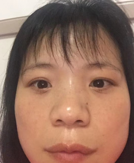 去眼袋手术