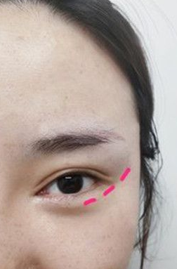 双眼皮手术