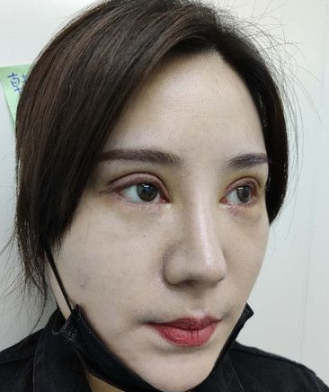 双眼皮手术