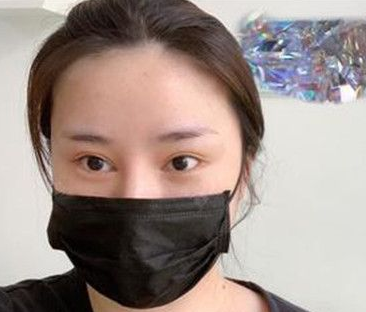 双眼皮手术