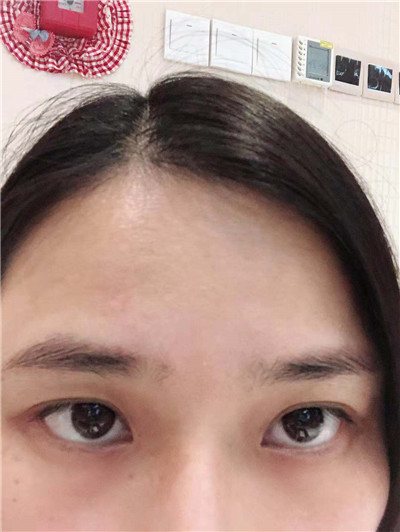 双眼皮手术