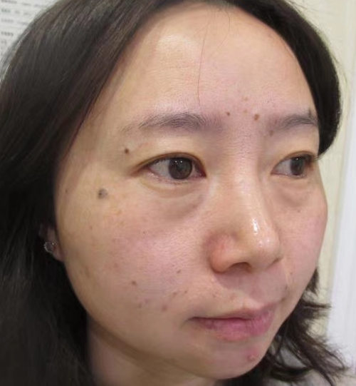去眼袋手术