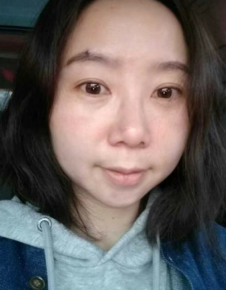 去眼袋手术