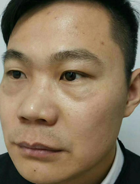 去眼袋手术