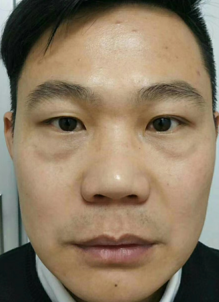 去眼袋手术