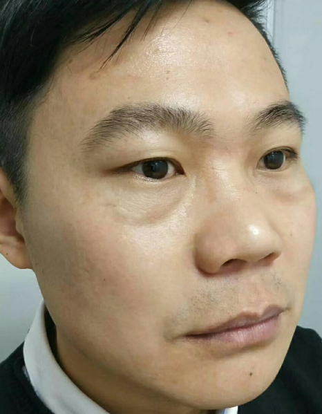 去眼袋手术