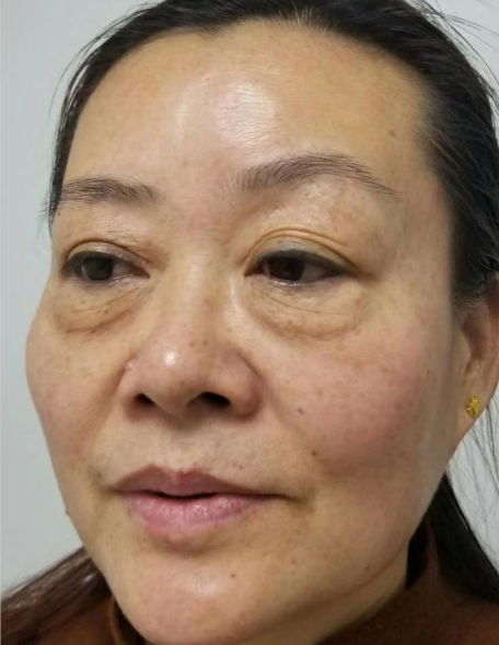 去眼袋手术