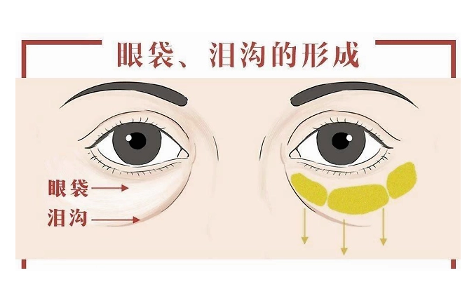 去眼袋手术