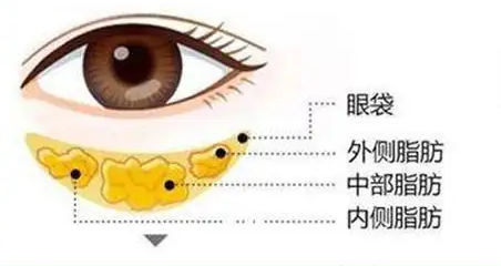 去眼袋手术