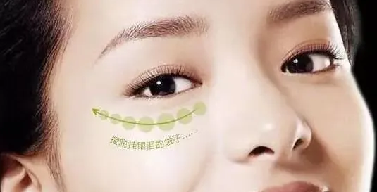 去眼袋手术