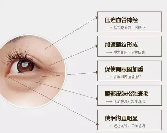 去眼袋手术