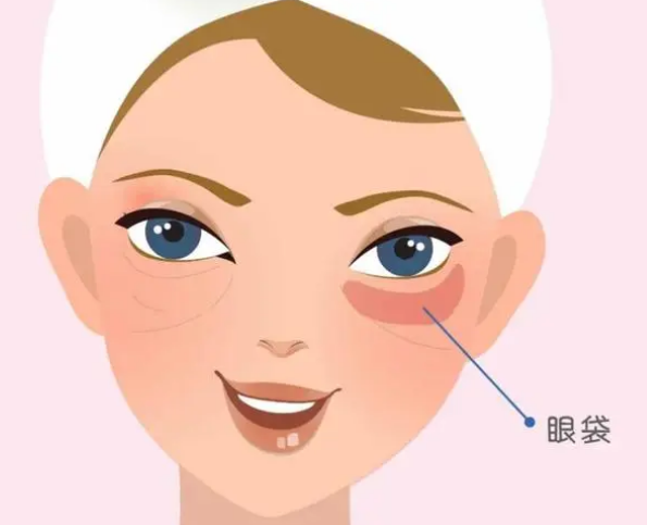 去眼袋手术