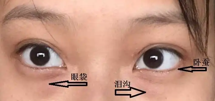 去眼袋手术