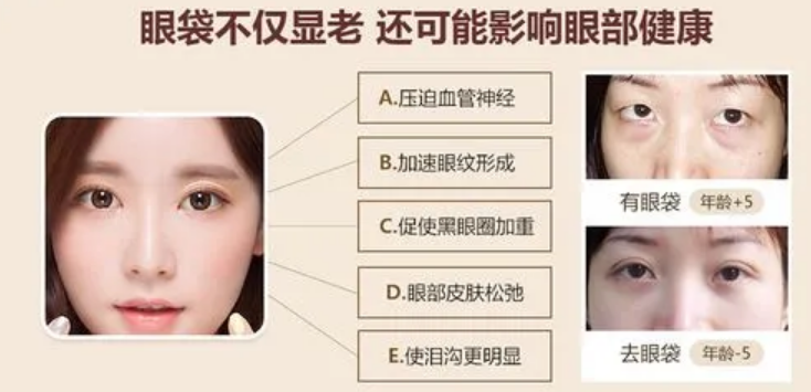 去眼袋手术