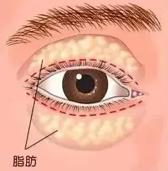 去眼袋手术