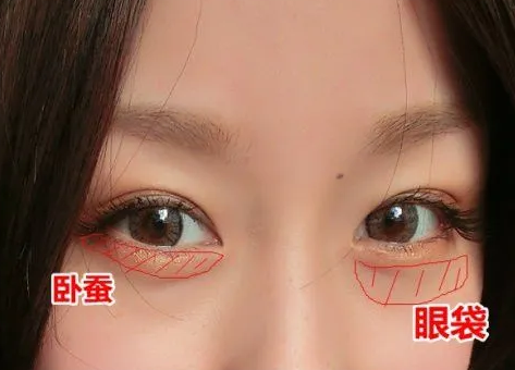 去眼袋手术