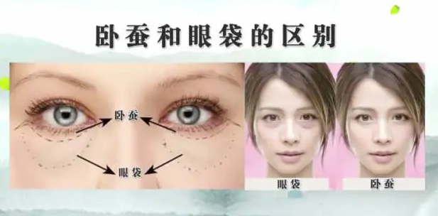 去眼袋手术