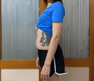 超声波减肥