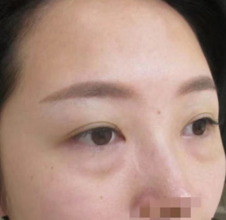 去眼袋手术