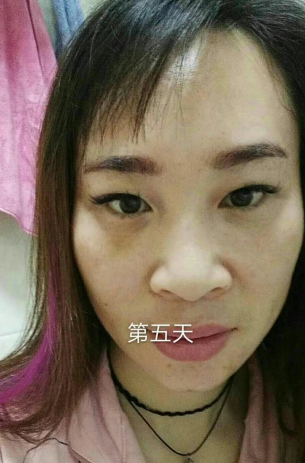 治疗眼袋也有心得,超雅做眼袋真的好!335 治疗眼袋也有心得,超雅做眼袋真的好!335