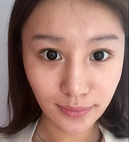 自体脂肪胶填充
