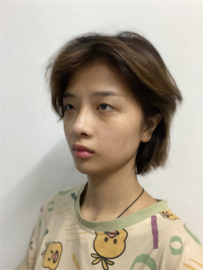 双眼皮手术