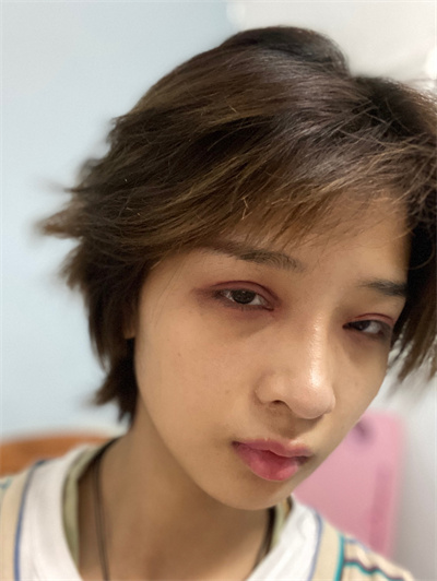 双眼皮手术