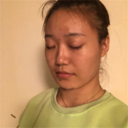 超声炮谁做过？有红肿吗？