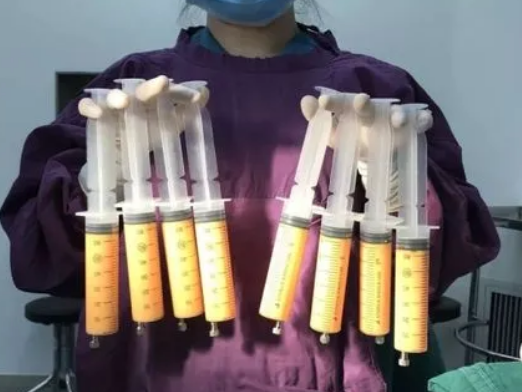 自体脂肪胶填充