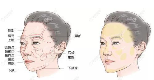 自体脂肪胶填充