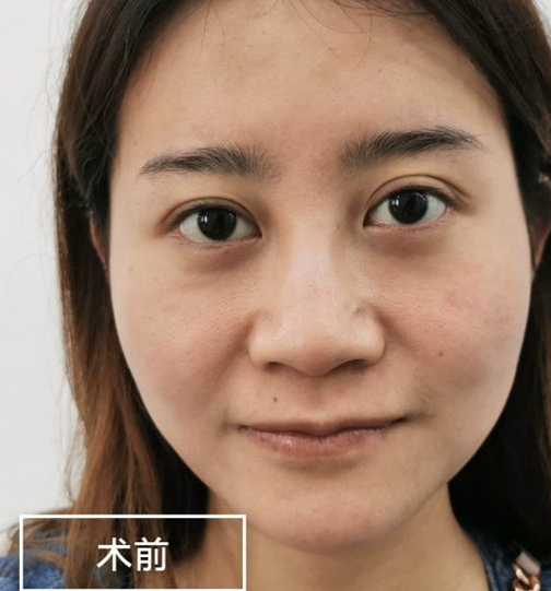 自体脂肪胶填充