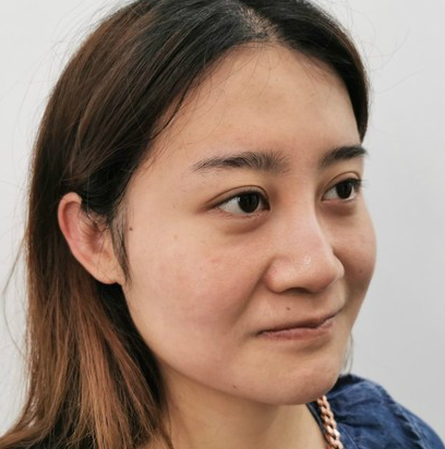 自体脂肪胶填充