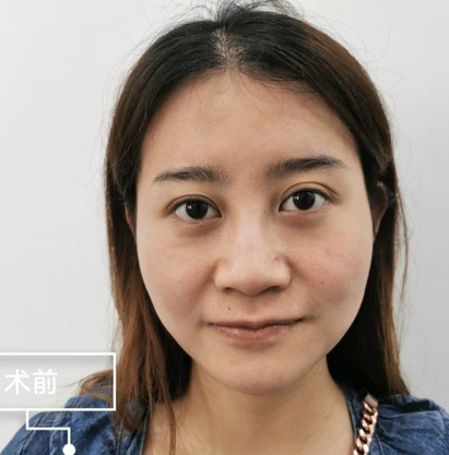 自体脂肪胶填充