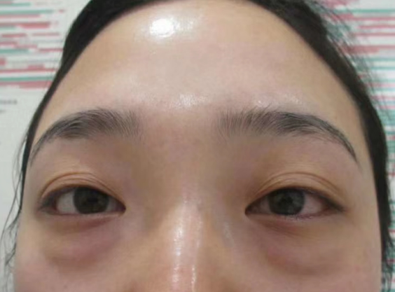 快速去眼袋且快速恢复的术式是什么?445 快速去眼袋且快速恢复的术式是什么?445