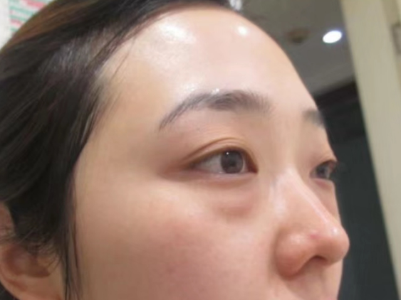快速去眼袋且快速恢复的术式是什么?445 快速去眼袋且快速恢复的术式是什么?445