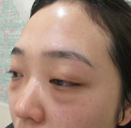 快速去眼袋且快速恢复的术式是什么?445 快速去眼袋且快速恢复的术式是什么?445