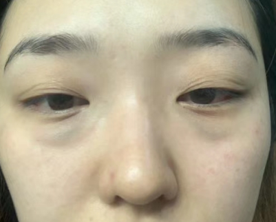快速去眼袋且快速恢复的术式是什么?445 快速去眼袋且快速恢复的术式是什么?445