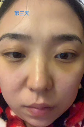 快速去眼袋且快速恢复的术式是什么?445 快速去眼袋且快速恢复的术式是什么?445