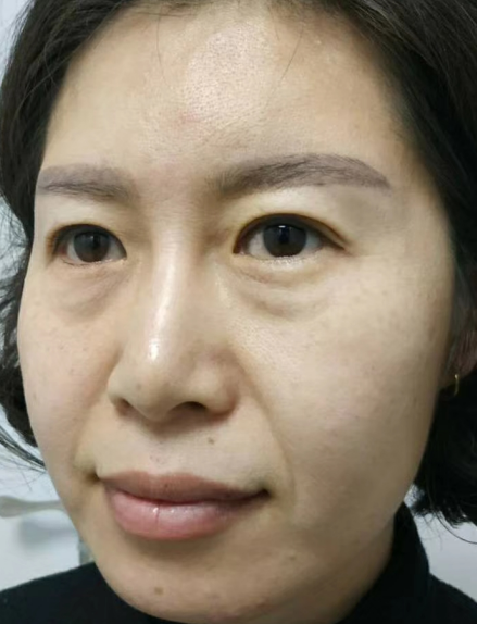 去眼袋手术