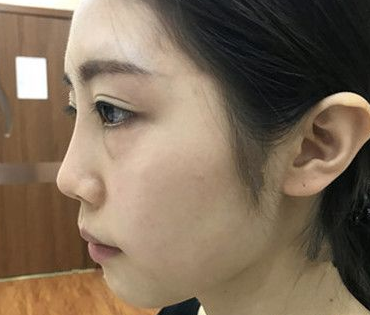 自体脂肪胶填充