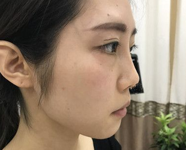 自体脂肪胶填充